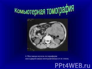 Комьютерная томография 4. Массивная опухоль по периферии нисходящей кишки неотгр