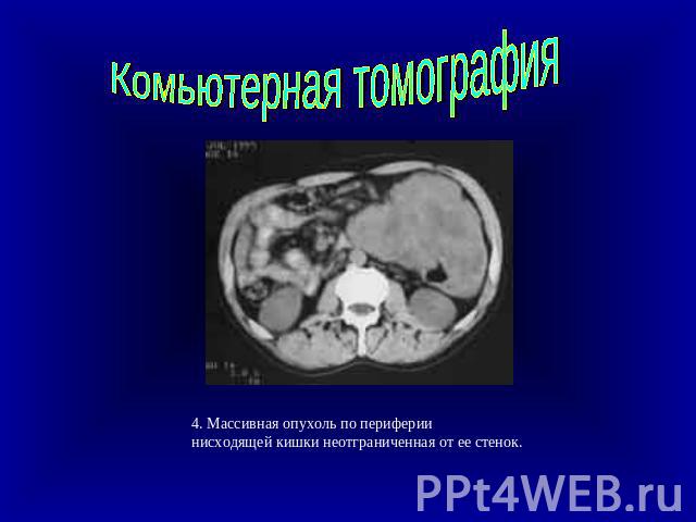 Комьютерная томография 4. Массивная опухоль по периферии нисходящей кишки неотграниченная от ее стенок.