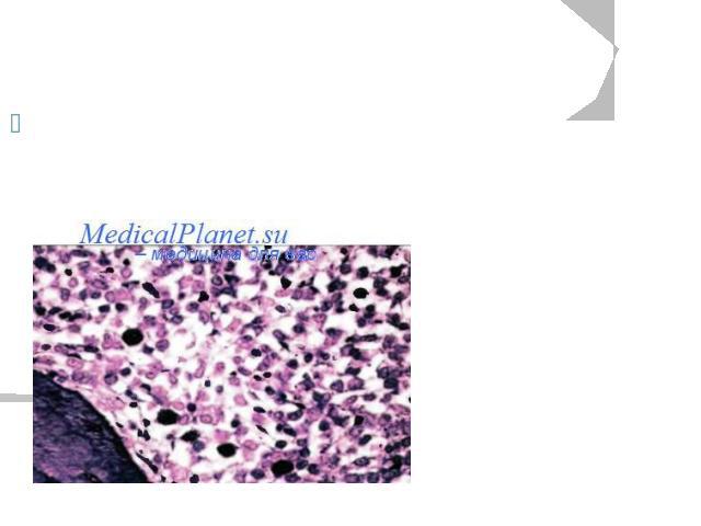 Патоморфология Верификация диагноза основана на выявлении гранулем, содержащих гистиоциты (клетки Лангерганса)Острый диссеминированный гистиоцитоз из клеток Лангерганса