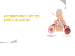 Астматический статус (Status astmaticus) — тяжёлое угрожающее жизни осложнение б