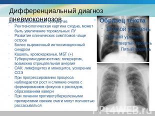 Дифференциальный диагноз пневмокониозов Диссеминированный туберкулезРентгенологи