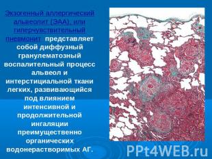 . Экзогенный аллергический альвеолит (ЭАА), или гиперчувствительный пневмонит пр