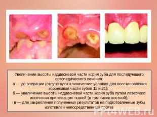 Увеличение высоты наддесневой части корня зуба для последующего ортопедического