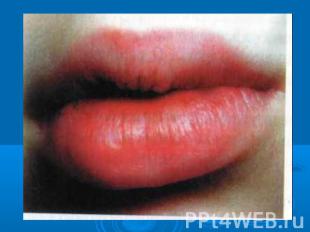 Презентация аллергия в полости рта