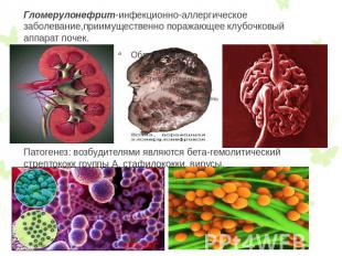 Гломерулонефрит-инфекционно-аллергическое заболевание,приимущественно поражающее