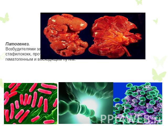 Пиелонефтир- это воспаление почечной лоханки и самой ткани почки. Патогенез.Возбудителями заболевания является кишечная палочка, стрептококк, стафилококк, протей, вирусы. Микробы попадают в почечную ткань гематогенным и восходящим путем.
