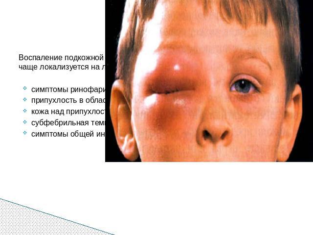 Воспаление подкожной клетчатки развивается у детей до 12 месяцев, чаще локализуется на лице, реже на конечностях. Клиника:симптомы ринофарингита; припухлость в области щеки или вокруг глазницы;кожа над припухлостью гиперемирована с цианотичным оттен…
