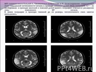 МРТ головного мозга больной А., Т2взвешенные изображения. а, б – 1е исследование