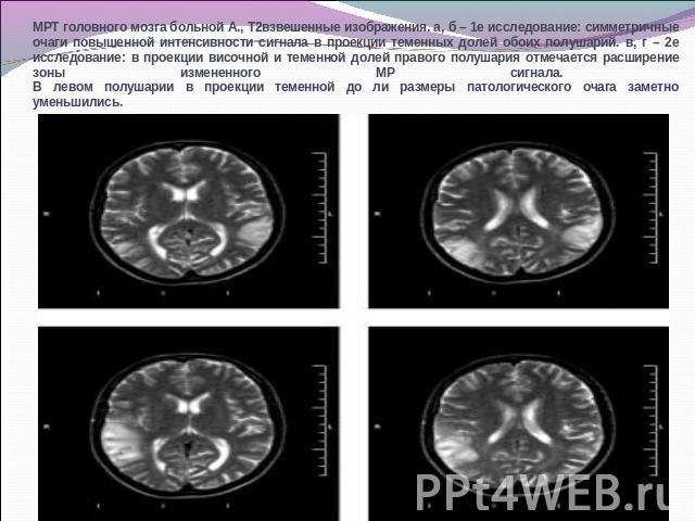 МРТ головного мозга больной А., Т2взвешенные изображения. а, б – 1е исследование: симметричные очаги повышенной интенсивности сигнала в проекции теменных долей обоих полушарий. в, г – 2е исследование: в проекции височной и теменной долей правого пол…