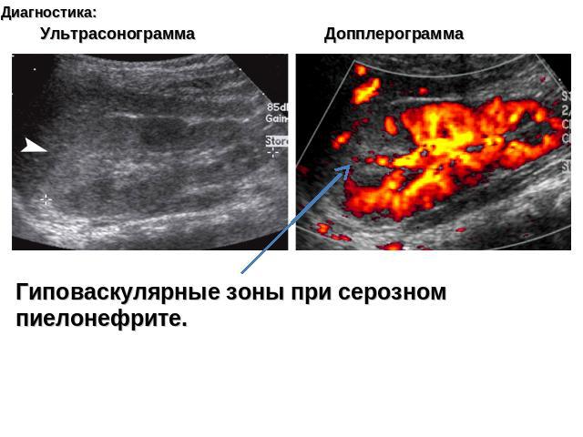 Диагностика: Ультрасонограмма Допплерограмма Гиповаскулярные зоны при серозном пиелонефрите.