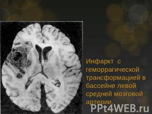 Инфаркт с геморрагической трансформацией в бассейне левой средней мозговой артер