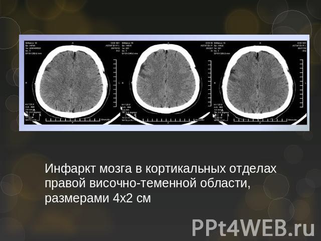 Инфаркт мозга в кортикальных отделах правой височно-теменной области, размерами 4х2 см