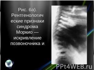 Рис. 6а). Рентгенологические признаки синдрома Моркио — искривление позвоночника
