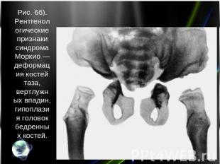 Рис. 6б). Рентгенологические признаки синдрома Моркио — деформация костей таза,