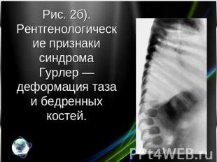 Рис. 2б). Рентгенологические признаки синдрома Гурлер — деформация таза и бедрен