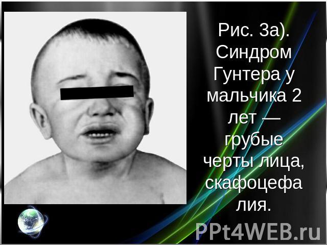 Рис. 3а). Синдром Гунтера у мальчика 2 лет — грубые черты лица, скафоцефалия.