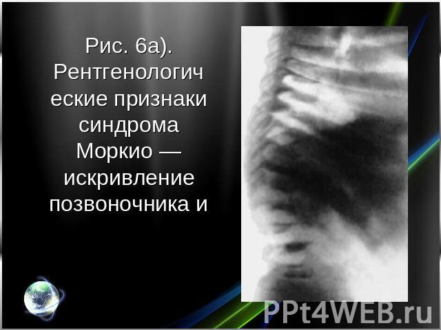 Рис. 6а). Рентгенологические признаки синдрома Моркио — искривление позвоночника и платиспондилия.