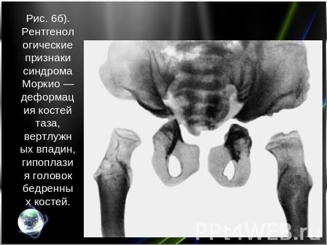 Рис. 6б). Рентгенологические признаки синдрома Моркио — деформация костей таза, вертлужных впадин, гипоплазия головок бедренных костей.