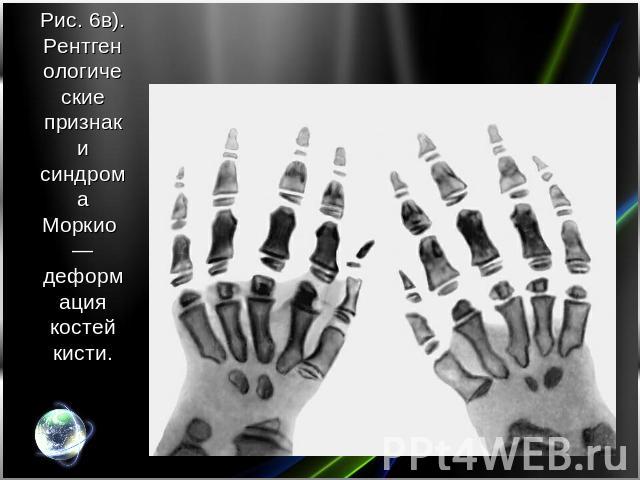 Рис. 6в). Рентгенологические признаки синдрома Моркио — деформация костей кисти.