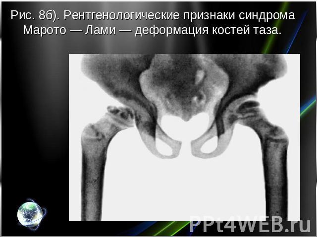 Рис. 8б). Рентгенологические признаки синдрома Марото — Лами — деформация костей таза.