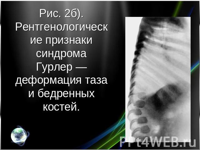 Рис. 2б). Рентгенологические признаки синдрома Гурлер — деформация таза и бедренных костей.