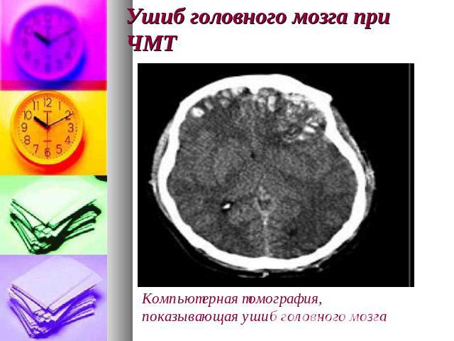 Ушиб головного мозга при ЧМТ Компьютерная томография, показывающая ушиб головного мозга