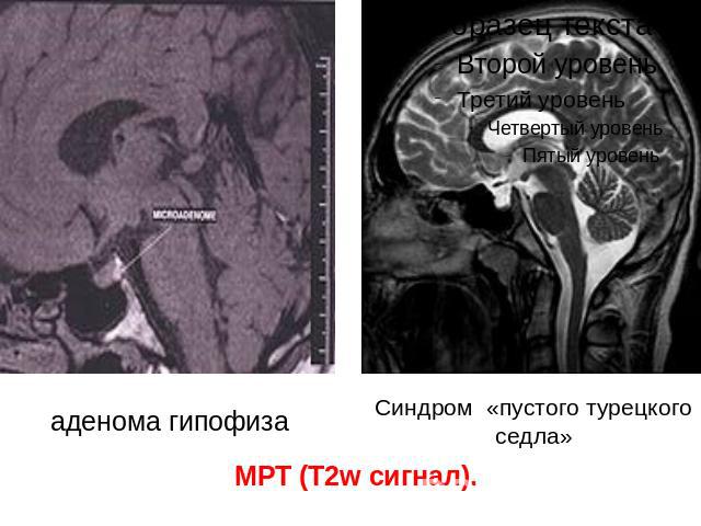 аденома гипофиза Синдром «пустого турецкого седла» МРТ (T2w сигнал).