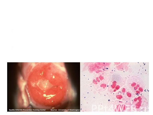 Экзо- и эндоцервицит Экзоцервицит- воспаление влагалищной части шейки матки.Эндоцервицит — воспаление слизистой оболочки цервикального канала шейки матки.