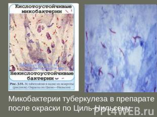 Микобактерии туберкулеза в препарате после окраски по Циль-Нильсену.