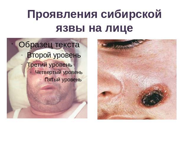 Проявления сибирской язвы на лице