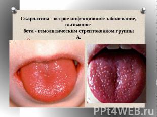 Скарлатина - острое инфекционное заболевание, вызванное бета - гемолитическим ст