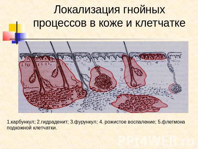 Локализация гнойных процессов в коже и клетчатке 1.карбункул; 2.гидраденит; 3.фурункул; 4. рожистое воспаление; 5.флегмонаподкожной клетчатки.
