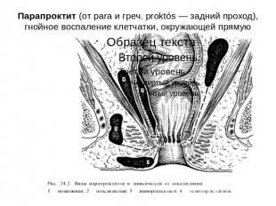 Парапроктит (от para и греч. proktós — задний проход), гнойное воспаление клетча