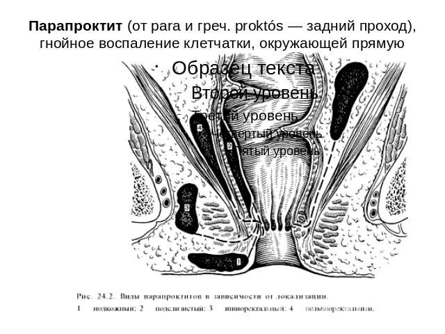 Парапроктит (от para и греч. proktós — задний проход), гнойное воспаление клетчатки, окружающей прямую кишку.