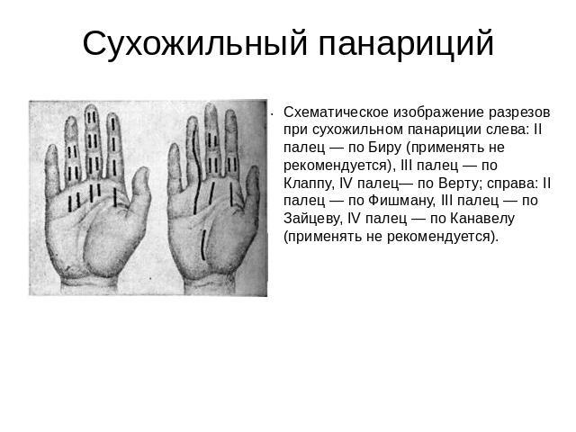 Сухожильный панариций Схематическое изображение разрезов при сухожильном панариции слева: II палец — по Биру (применять не рекомендуется), III палец — по Клаппу, IV палец— по Верту; справа: II палец — по Фишману, III палец — по Зайцеву, IV палец — п…