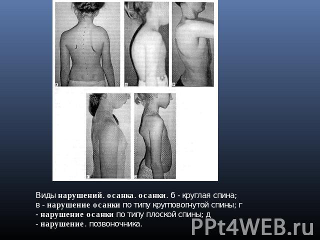 Виды нарушений. осанка. осанки. б - круглая спина; в - нарушение осанки по типу кругповогнутой спины; г - нарушение осанки по типу плоской спины; д - нарушение. позвоночника.