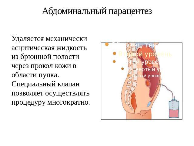 Абдоминальный парацентез Удаляется механически асцитическая жидкость из брюшной полости через прокол кожи в области пупка. Специальный клапан позволяет осуществлять процедуру многократно.