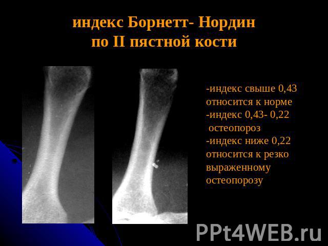 индекс Борнетт- Нординпо II пястной кости -индекс свыше 0,43 относится к норме-индекс 0,43- 0,22 остеопороз-индекс ниже 0,22относится к резко выраженному остеопорозу