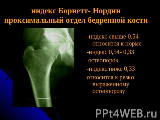 индекс Борнетт- Нординпроксимальный отдел бедренной кости -индекс свыше 0,54 относится к норме-индекс 0,54- 0,33 остеопороз-индекс ниже 0,33относится к резко выраженному остеопорозу