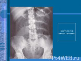 Раздутые петли тонкого кишечника