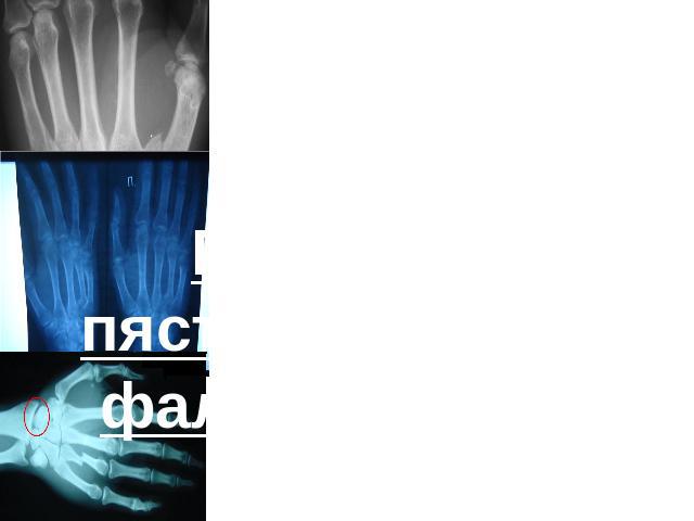 Переломы пястных костей и фаланг пальцев