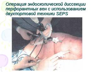 Операция эндоскопической диссекции перфорантных вен с использованием двухпортово