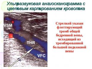 Ультразвуковая ангиосканограмма с цветовым картированием кровотока Стрелкой указ