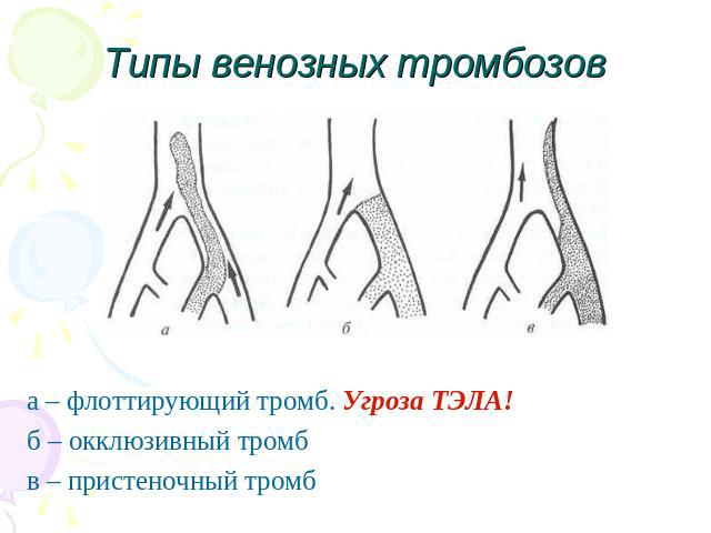 Типы венозных тромбозов а – флоттирующий тромб. Угроза ТЭЛА!б – окклюзивный тромбв – пристеночный тромб