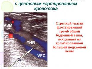 Ультразвуковая ангиосканограмма с цветовым картированием кровотока Стрелкой указ