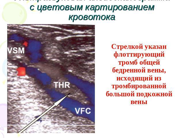 Ультразвуковая ангиосканограмма с цветовым картированием кровотока Стрелкой указан флоттирующий тромб общей бедренной вены, исходящий из тромбированной большой подкожной вены