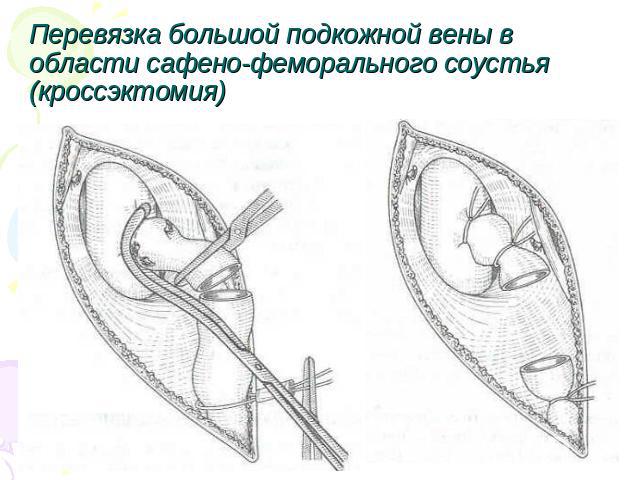 Перевязка большой подкожной вены в области сафено-феморального соустья (кроссэктомия)