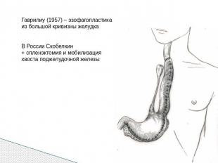 Гаврилиу (1957) – эзофагопластика из большой кривизны желудкаВ России Скобелкин+