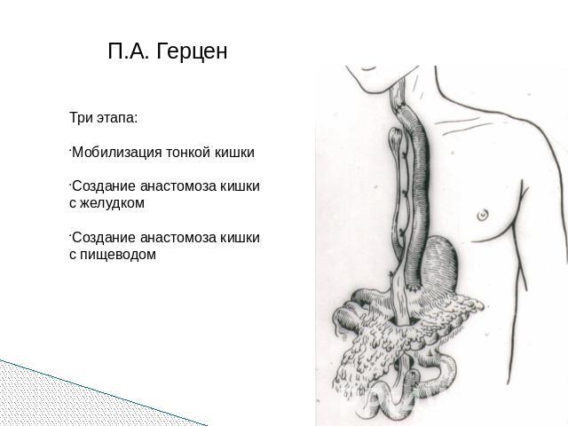 П.А. Герцен Три этапа: Мобилизация тонкой кишкиСоздание анастомоза кишки с желудкомСоздание анастомоза кишки с пищеводом