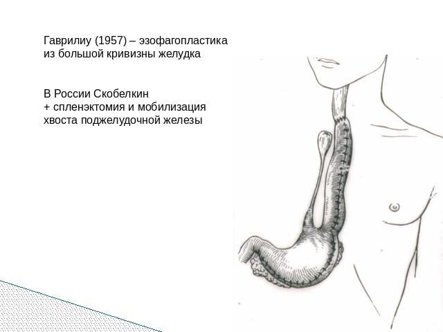 Гаврилиу (1957) – эзофагопластика из большой кривизны желудкаВ России Скобелкин+ спленэктомия и мобилизация хвоста поджелудочной железы